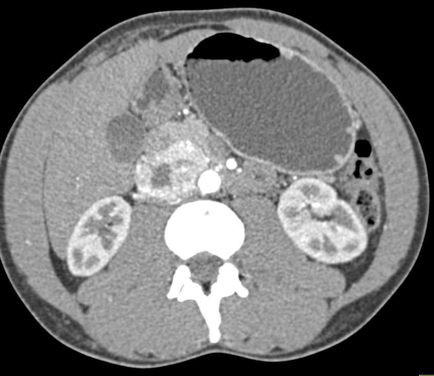 Neuroendocrine Tumor in the Head of the Pancreas - CTisus CT Scan