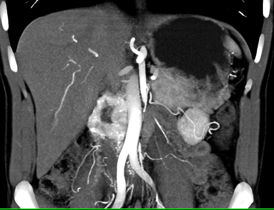 Neuroendocrine Tumor in the Head of the Pancreas - CTisus CT Scan