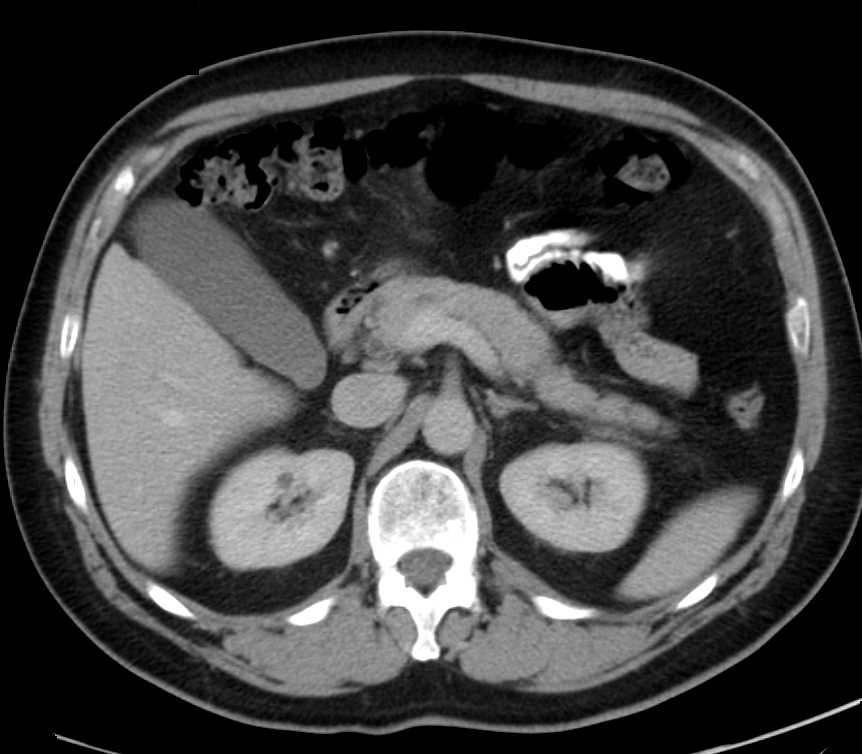 Carcinoma of the Head of the Pancreas - CTisus CT Scan