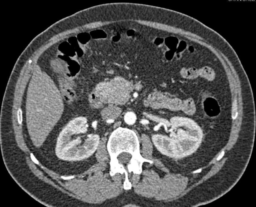 Carcinoma of the Head of the Pancreas - CTisus CT Scan