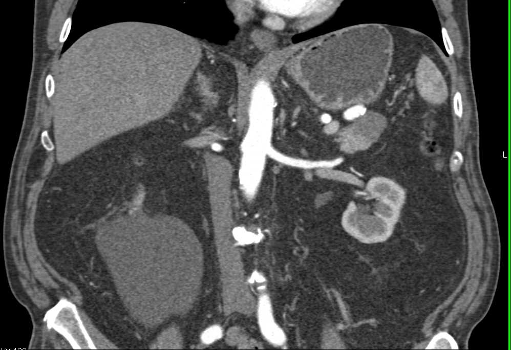 Carcinoma in the Tail of the Pancreas - CTisus CT Scan