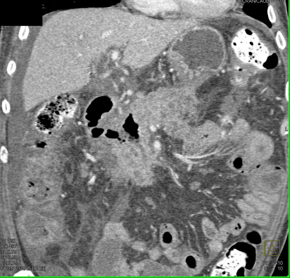 Pancreatic Cancer Invades the Duodenum - CTisus CT Scan