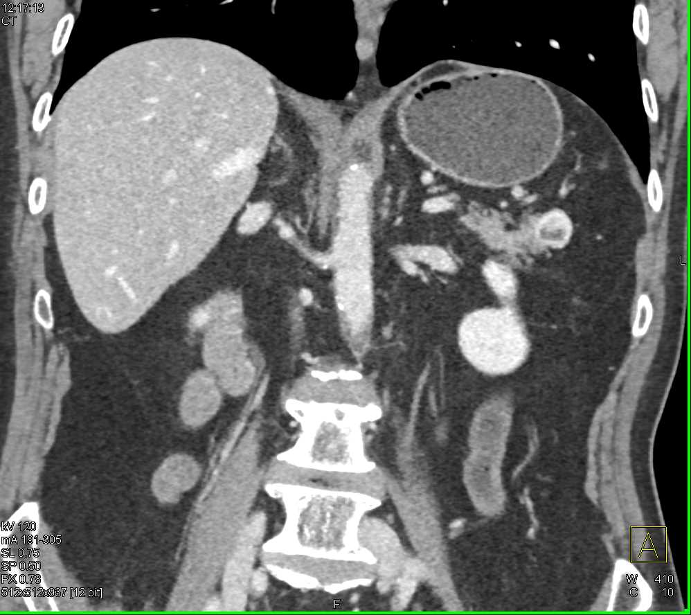 Cystic Neuroendocrine Tumor in the Tail of the Pancreas - CTisus CT Scan