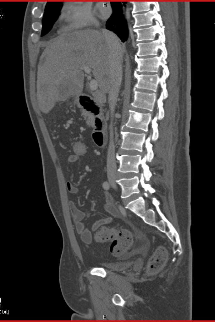 Pancreatic Cancer with Liver and Bone Metastases - CTisus CT Scan