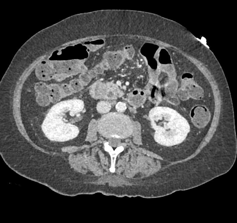 Pancreatic Cancer with Double Duct Sign - CTisus CT Scan