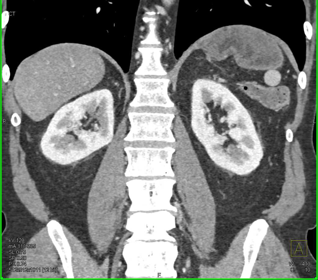 Omental Infarct Following Distal Pancreatectomy and Splenectomy - CTisus CT Scan