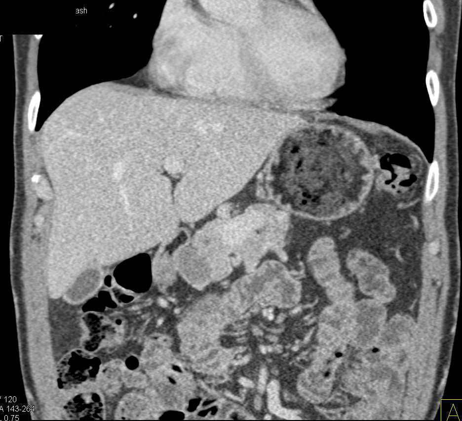 Adenocarcinoma of the Head of the Pancreas - CTisus CT Scan