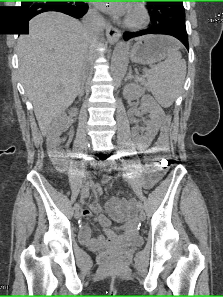 Large Nodes Simulate a Pancreatic Mass - CTisus CT Scan