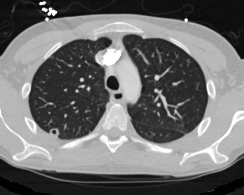 Pancreatic Cancer with Septic Emboli - CTisus CT Scan