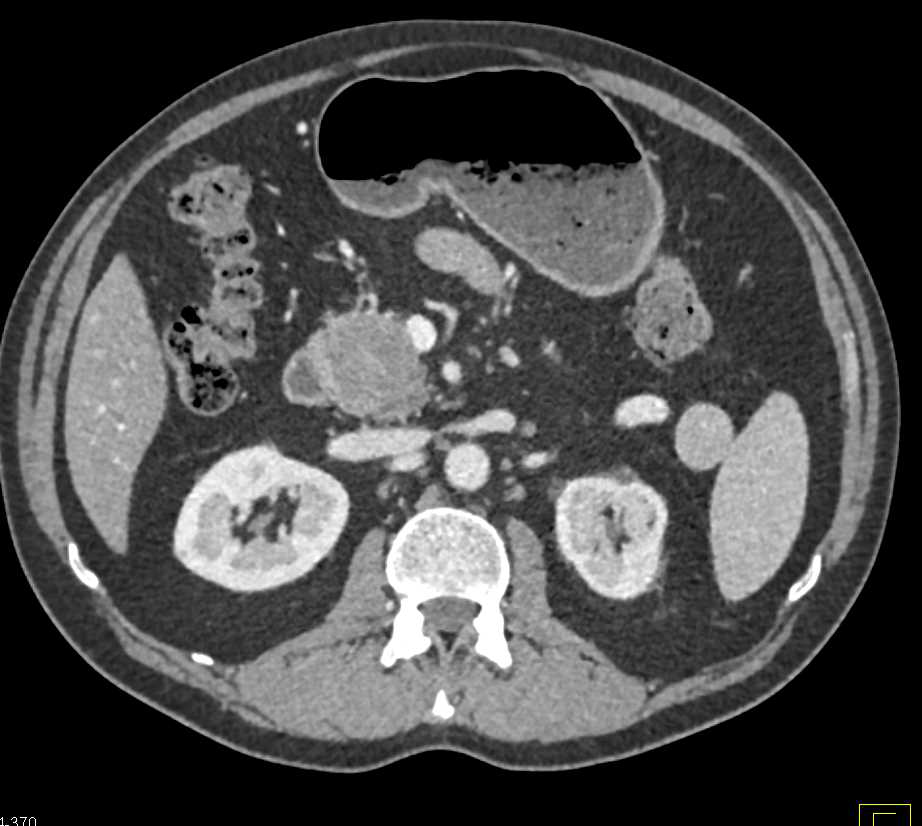 Carcinoma of the Head of the Pancreas - CTisus CT Scan