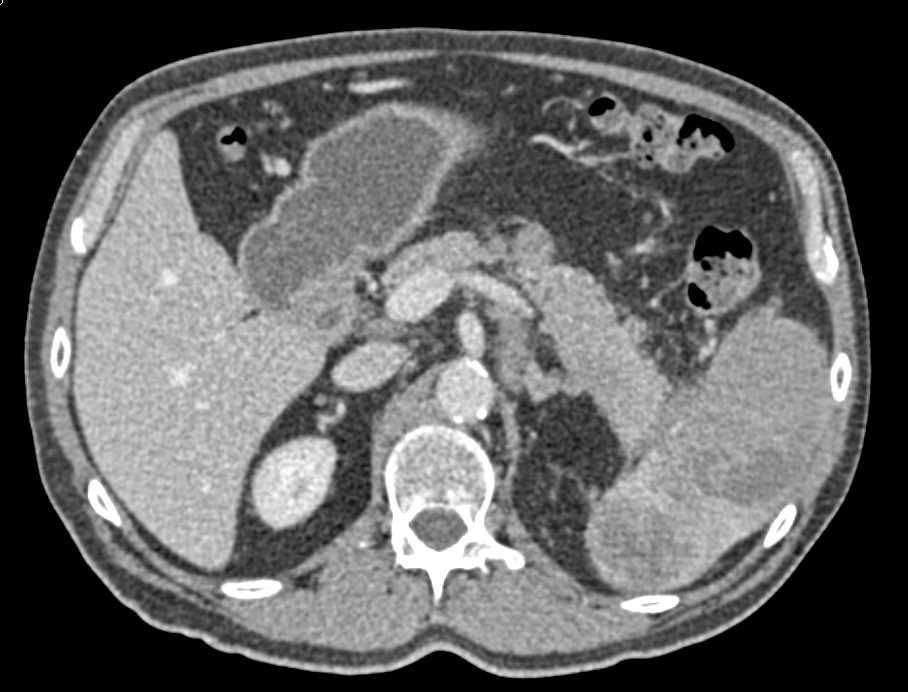 Carcinoma of the Tail of the Pancreas Invades the Spleen - CTisus CT Scan