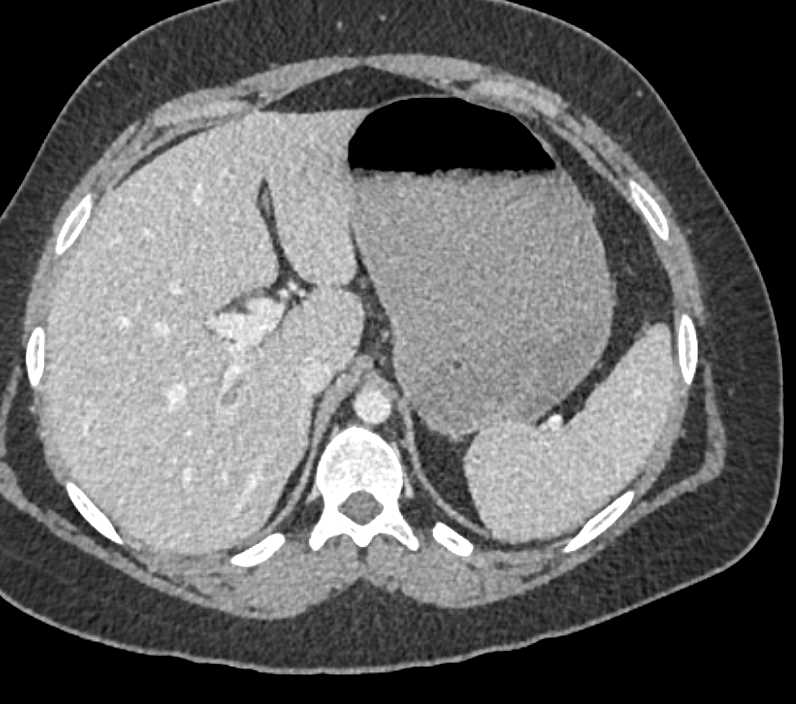 Subtle Carcinoma in the Head of the Pancreas and Thrombus in the Right Portal Vein - CTisus CT Scan