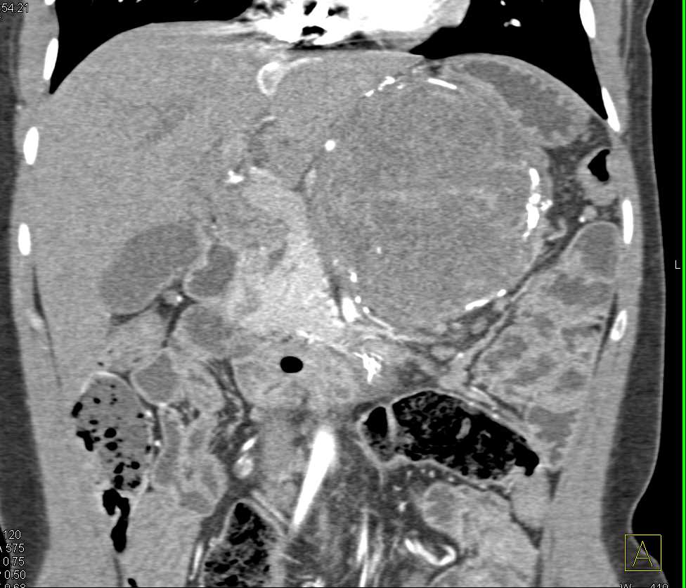 Solid and Papillary Epithelial Neoplasm (SPEN) Tumor in the Tail of the Pancreas with Calcifications and Stent in Duodenum - CTisus CT Scan