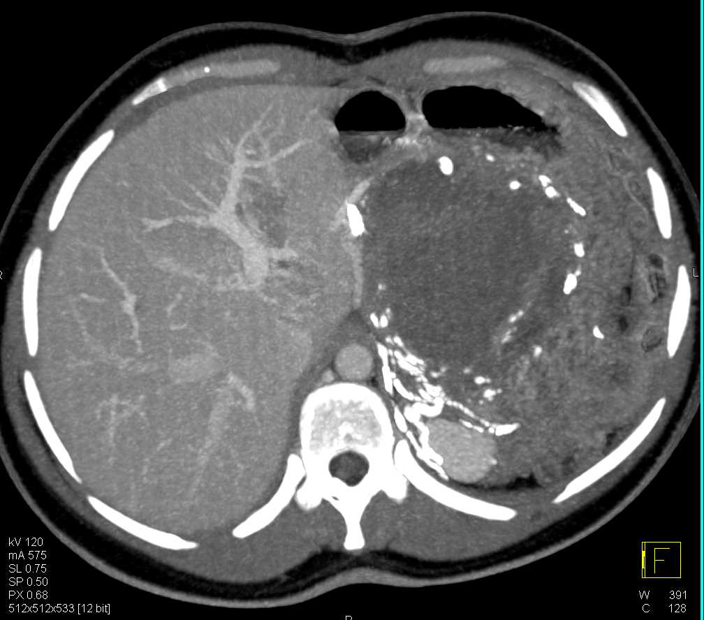 Solid and Papillary Epithelial Neoplasm (SPEN) Tumor in the Tail of the Pancreas with Calcifications and Stent in Duodenum - CTisus CT Scan