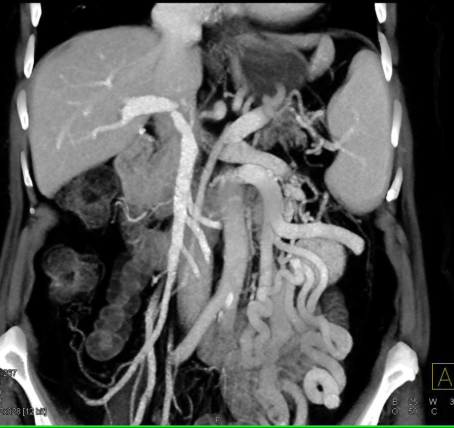 Invasive Pancreatic Cancer with Extensive Collateral Flow due to PV/SMV/Splenic Vein Encasement - CTisus CT Scan