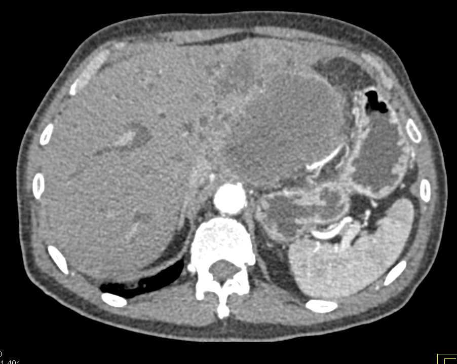 Invasive Pancreatic Cancer with Extensive Collateral Flow due to PV/SMV/Splenic Vein Encasement - CTisus CT Scan