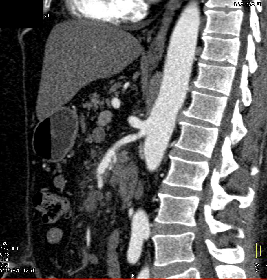 Pancreatic Cancer Encases the Superior Mesenteric Artery (SMA) and the PV/SMV Junction - CTisus CT Scan