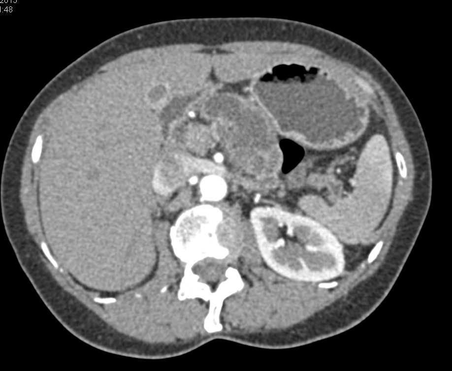 Adenocarcinoma Arising from an Intraductal Papillary Mucinous Neoplasm (IPMN) - CTisus CT Scan