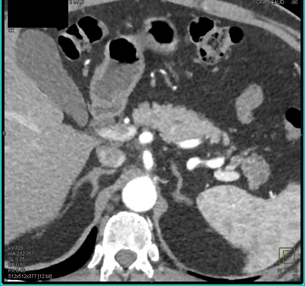 Dysplastic Nodule in the Tail of the Pancreas - CTisus CT Scan