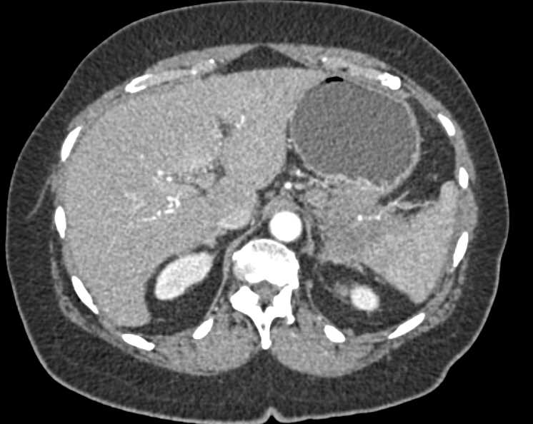 Carcinoma Tail of the Pancreas with Carcinomatosis - CTisus CT Scan