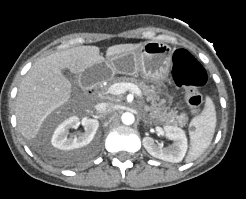 Acute Pancreatitis as a Post Endoscopic Retrograde Cholangiopancreatography (ERCP) Complication - CTisus CT Scan