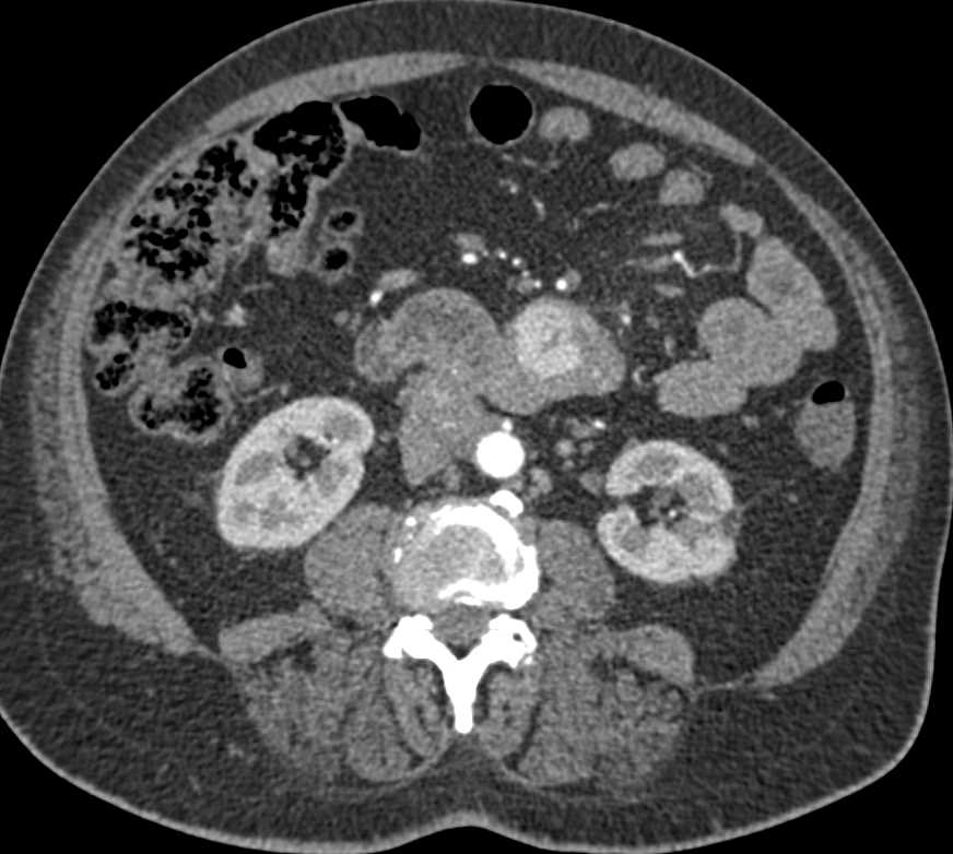 Neuroendocrine Tumor with Extensive Adenopathy - CTisus CT Scan