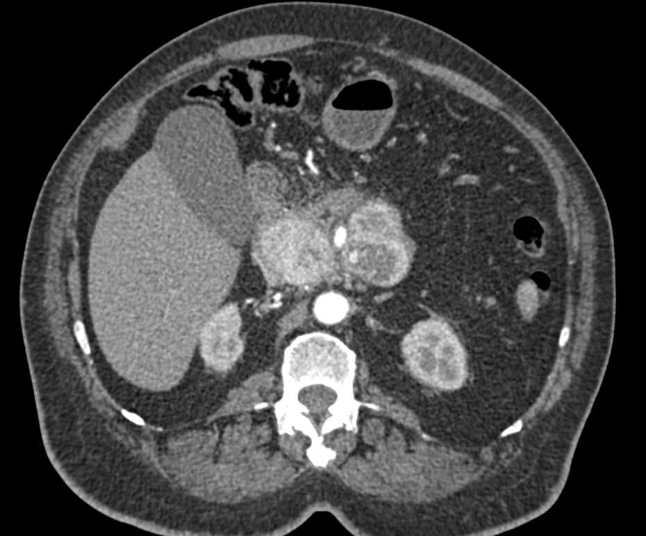 Neuroendocrine Tumor with Extensive Adenopathy - CTisus CT Scan