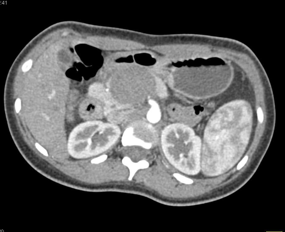 Solid and Papillary Epithelial Neoplasm (SPEN) Tumor Pancreas - CTisus CT Scan