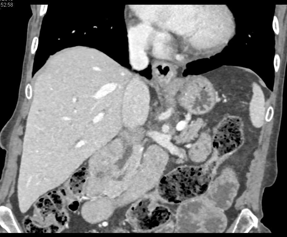 Ampullary Carcinoma with a Double Duct Sign - CTisus CT Scan