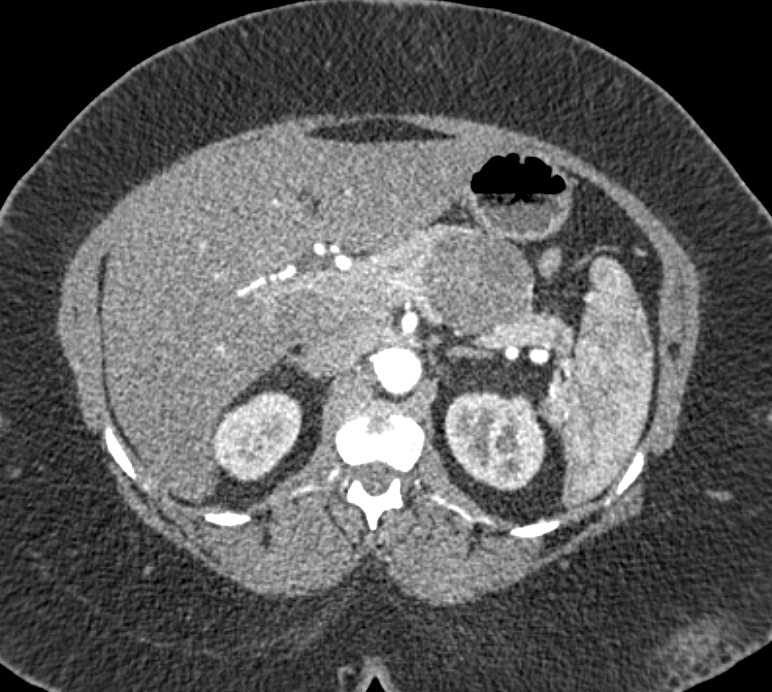 Mucinous Cystic Neoplasm of the Pancreas (MCN) - CTisus CT Scan