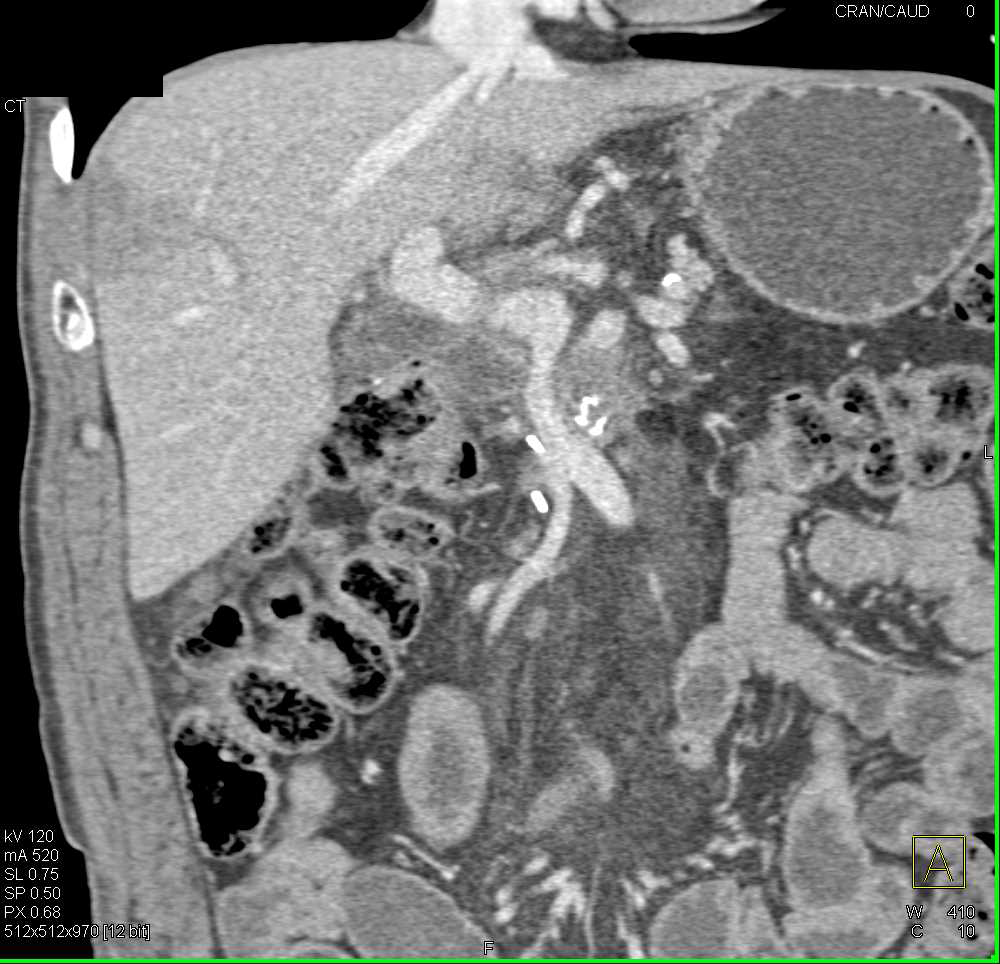 Liver Abscess in a Patient S/P Whipple Procedure - CTisus CT Scan