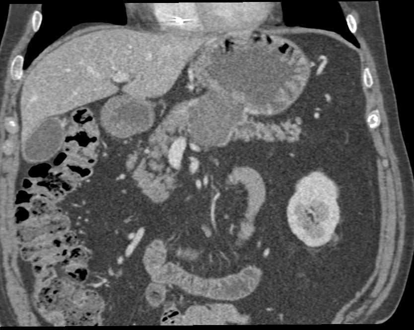 Serous Cystadenoma in the Body of the Pancreas - CTisus CT Scan