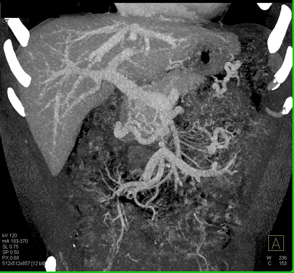 Pancreatic Cancer Encases PV/SMV/SV Junction - CTisus CT Scan