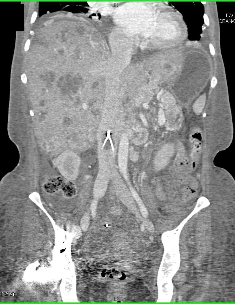 Neuroendocrine Tumor of the Pancreas with Liver and Adrenal Metastases - CTisus CT Scan