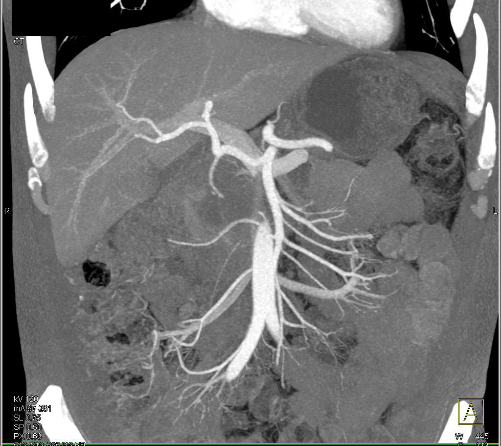 Carcinoma of the Head of the Pancreas Obstructs the Pancreatic Duct - CTisus CT Scan