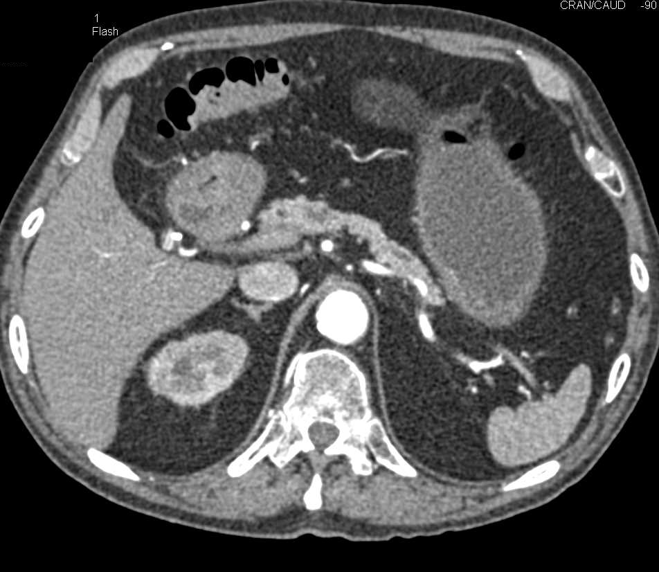 Multiple Intraductal Papillary Mucinous Neoplasms (IPMNs) - CTisus CT Scan