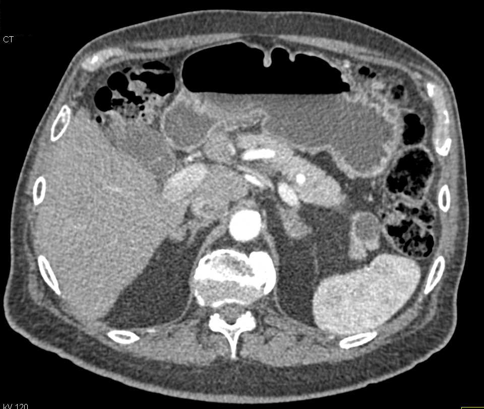 Intraductal Papillary Mucinous Neoplasm (IPMN) Tail of the Pancreas - CTisus CT Scan