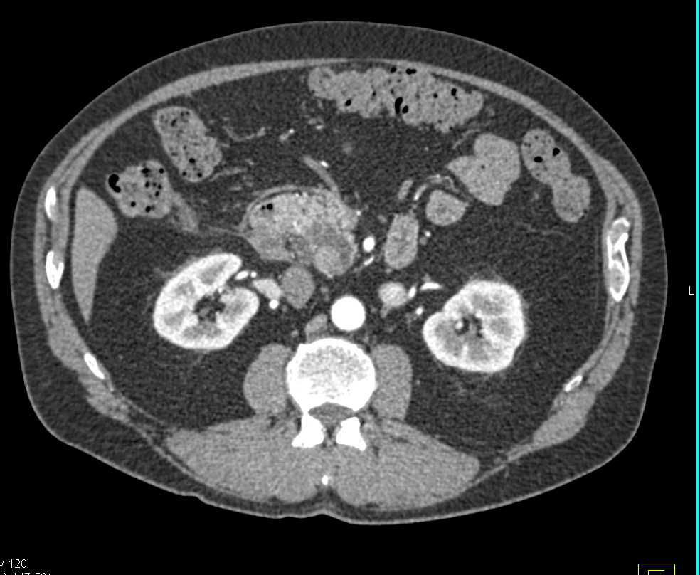 Pancreatic Carcinoma Arising in an Intraductal Papillary Mucinous Neoplasm (IPMN) - CTisus CT Scan