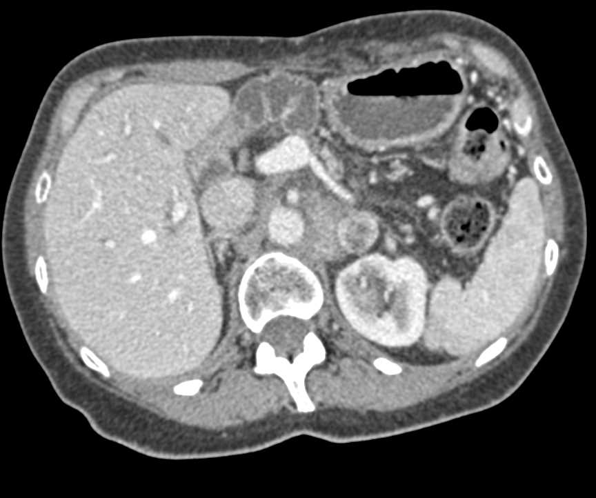 Recurrent Pancreatic Cancer with Adenopathy - CTisus CT Scan