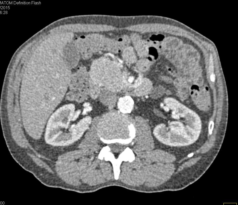 Carcinoma of the Head of the Pancreas - CTisus CT Scan