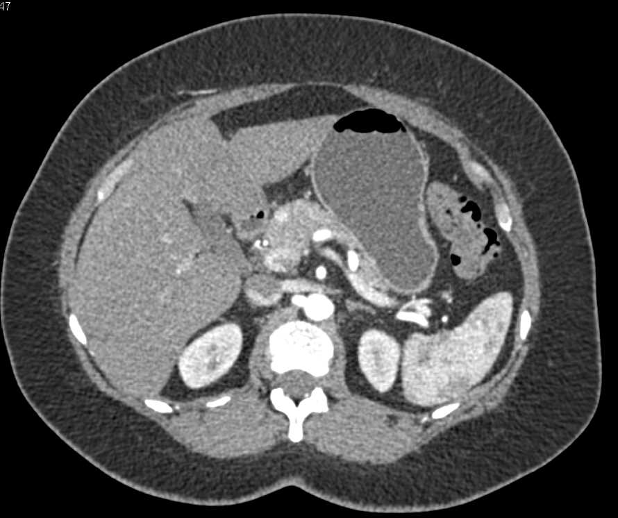 Incidental 1cm Neuroendocrine Tumor in the Head of the Pancreas - CTisus CT Scan