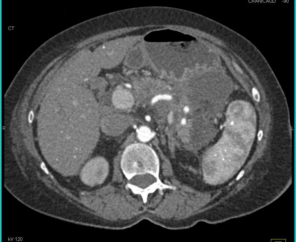 Acute Pancreatitis with Extensive Inflammation - CTisus CT Scan