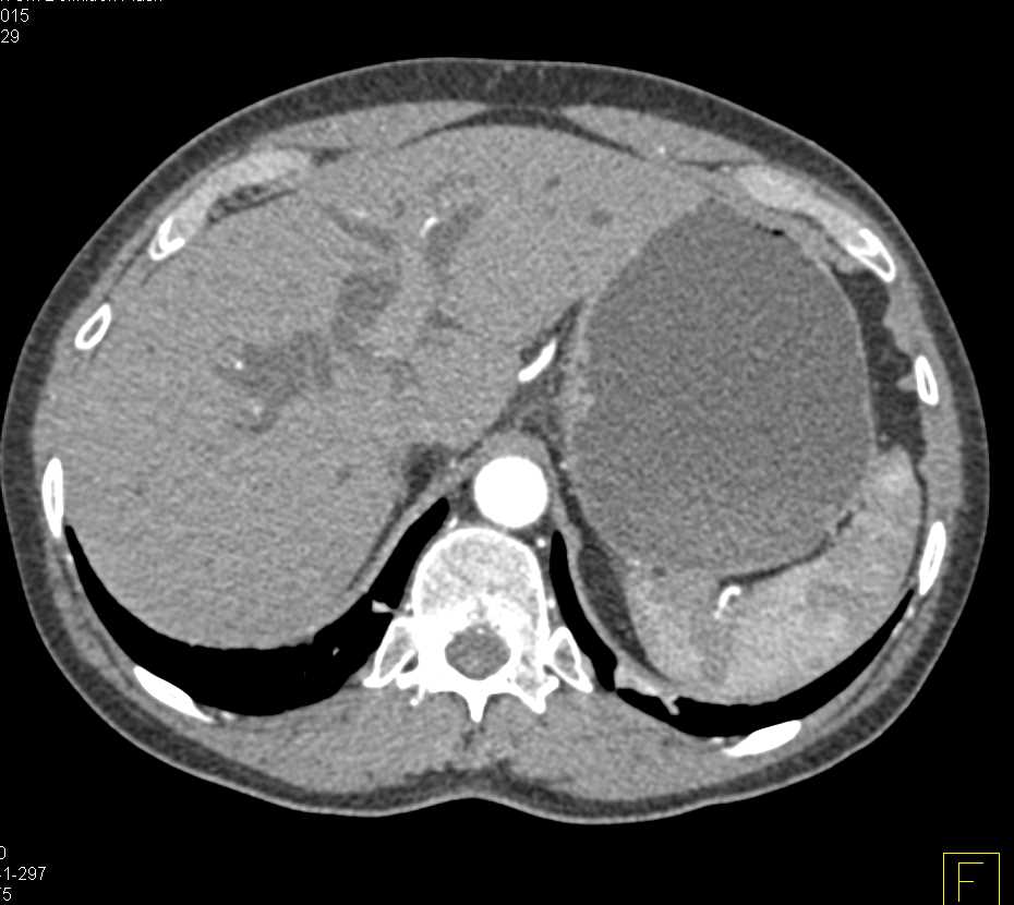 Carcinoma of the Pancreas Obstructs the Common Duct - CTisus CT Scan