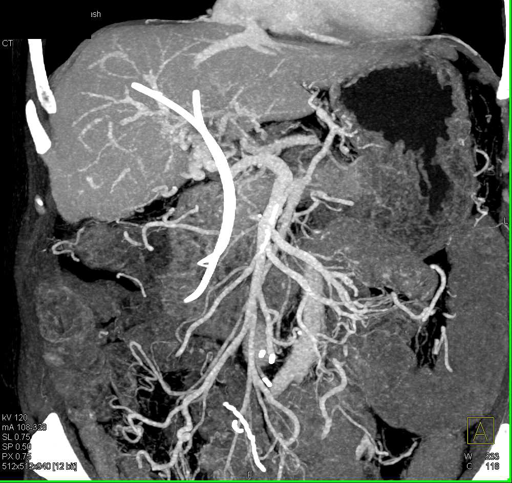 Carcinoma Tail of the Pancreas with Widespread Metastases - CTisus CT Scan