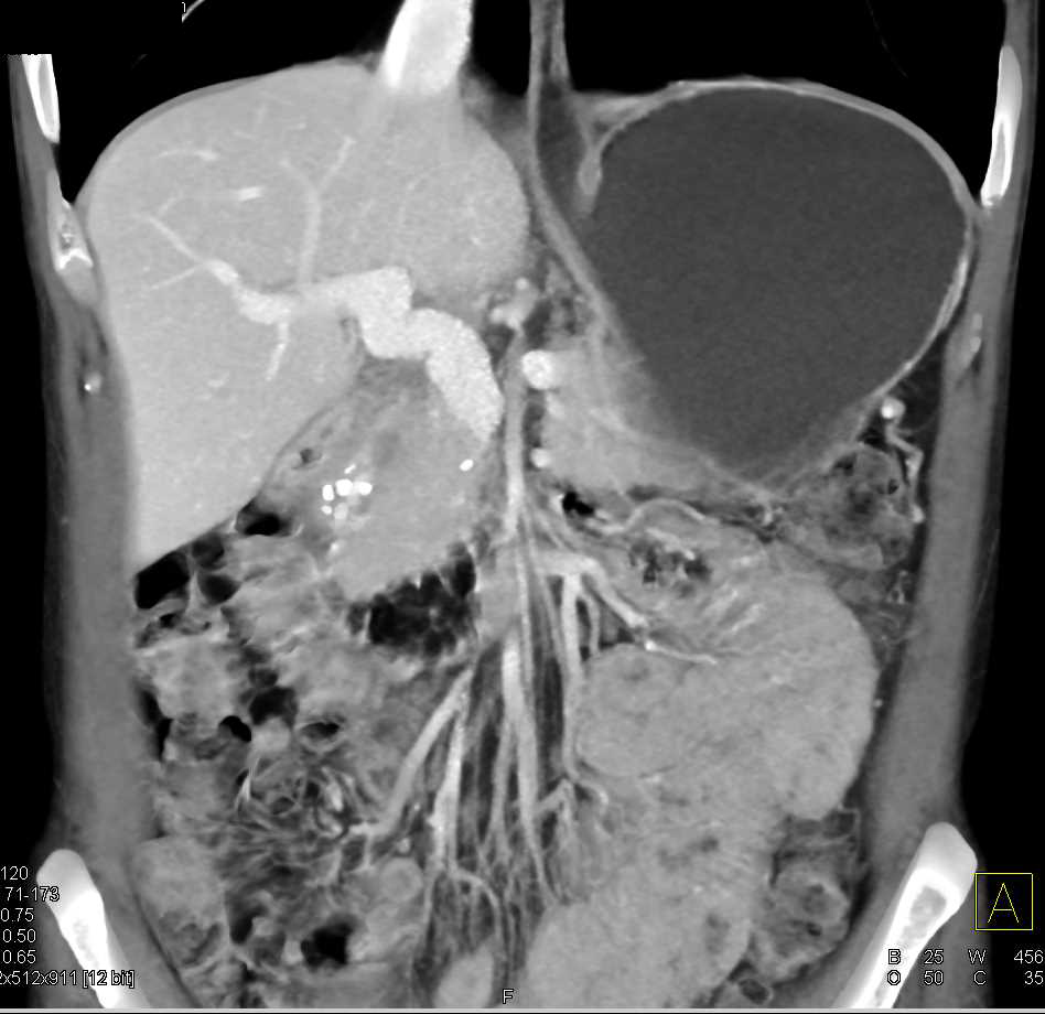 Pseudomass Head of Pancreas due to Chronic and Acute Pancreatitis - CTisus CT Scan