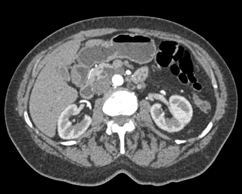 Intraductal Papillary Mucinous Neoplasm (IPMN) in the Head of the Pancreas - CTisus CT Scan