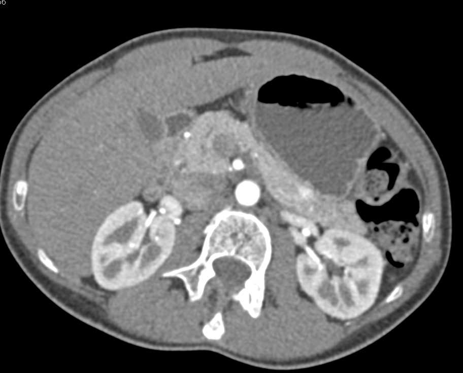 Incidental Neuroendocrine Tumor of the Pancreas - CTisus CT Scan