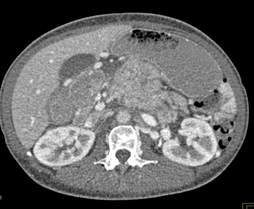 Neuroendocrine Tumor of the Pancreas Invades the Portal Vein with Cavernous Transformation of the Portal Vein (CTPV) - CTisus CT Scan