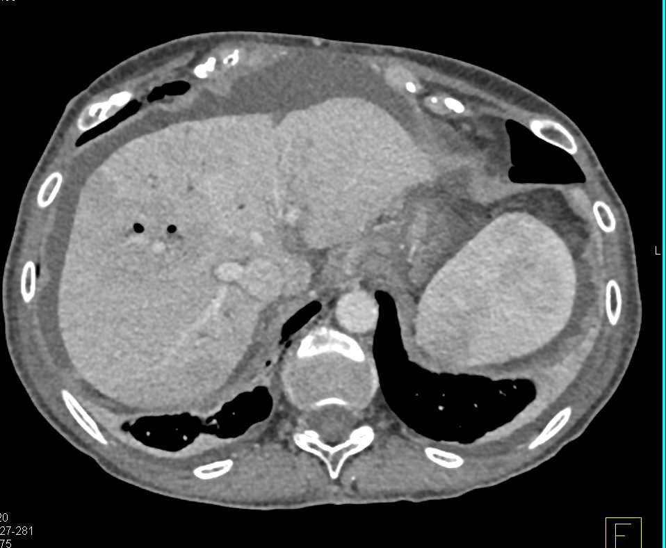 Pancreatic Cancer Infiltrates the Hilum of the Liver - CTisus CT Scan