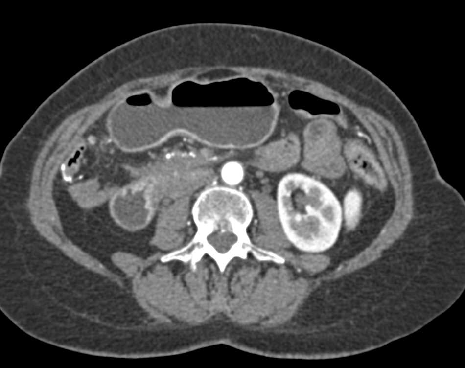 Carcinoma Head of the Pancreas Invades the Duodenum - CTisus CT Scan